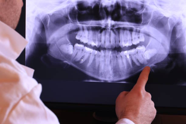 Best Emergency Wisdom Teeth Removal in Lafayette, GA